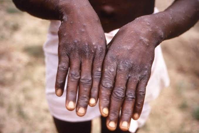 Mpox : le gouvernement note une augmentation des cas suspects et une hausse de la létalité